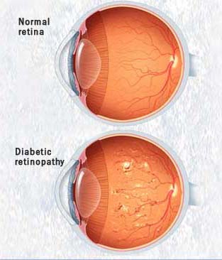 اثرات جبران ناپذر دیابت بر چشم